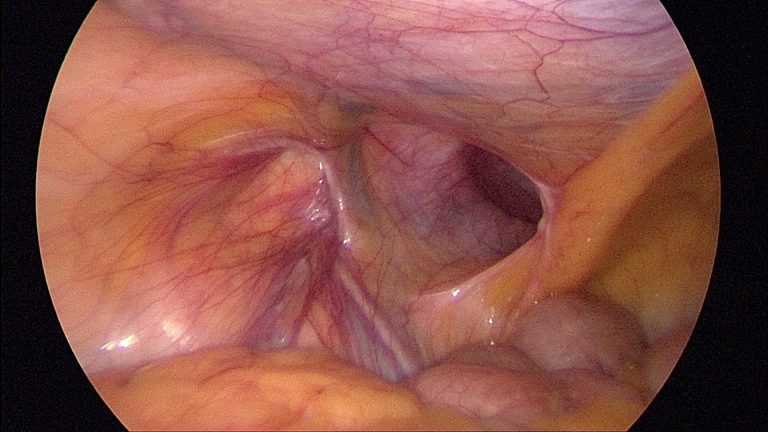 腹腔鏡でそけい部を腹腔内から観察すると、ヘルニア門（ヘルニアの出口）を直接観察することができます。