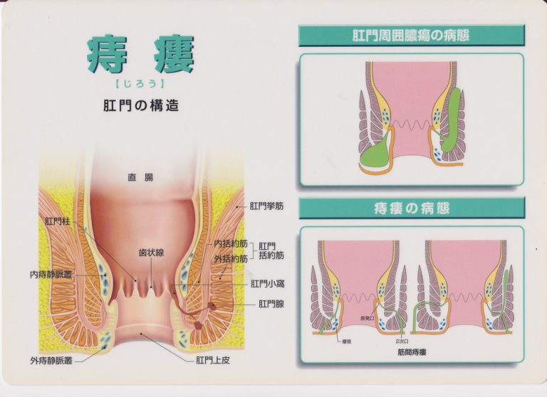 あな痔（痔ろう）