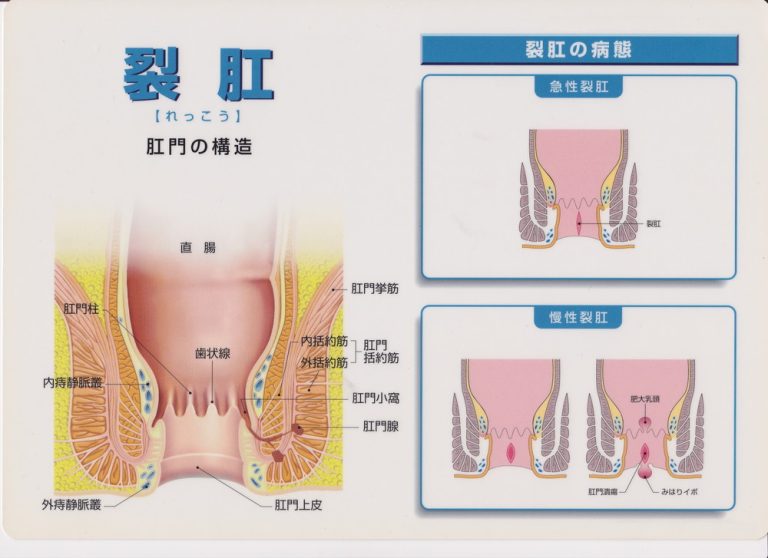 きれ痔（裂肛）