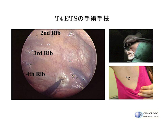 T4ETSの手術手技