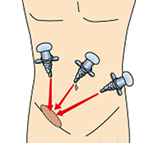 お腹の傷がより小さな「腹腔鏡鼠径ヘルニア手術（TAPP法）」