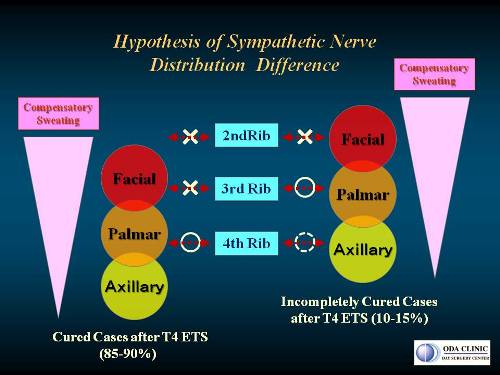  低位交感神経遮断手術（T4-ETS）後に少し手汗がでる場合の神経分布の個人差