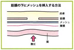 院長が得意とするクーゲル法