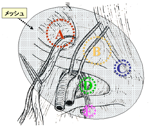 再発の危険が少ない