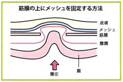 院長が得意とするクーゲル法