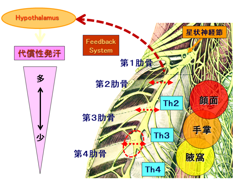 多汗症手術