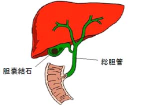 胆石症とは