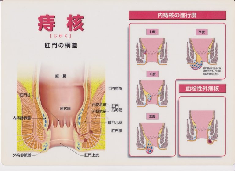 いぼ痔（痔核）