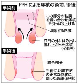 肛門を切開しないPPH手術