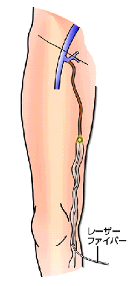 レーザーまたは高周波（ラジオ波）による血管内焼灼術