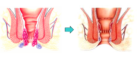 痔疾患　PPHの原理