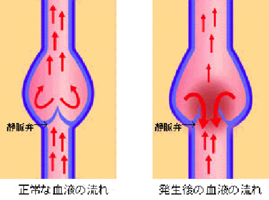 下肢静脈瘤とはどんな病気ですか？