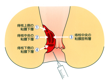 痔の疾患