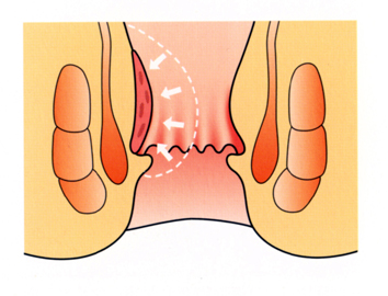 痔の疾患
